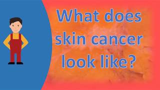 What does skin cancer look like  Best Health FAQS [upl. by Letsirhc941]