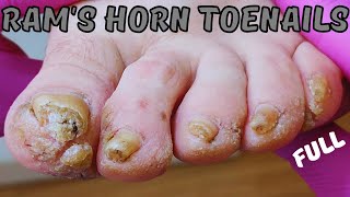 11 05 Rams horn toenails Eczemodermatitis [upl. by Enattirb122]