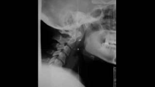 ArnoldChiari Malformation [upl. by Kimble256]