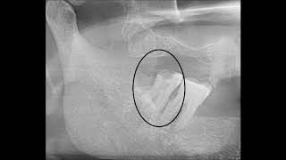 Grossly decayed lower 3rd molar extraction [upl. by Aruat846]