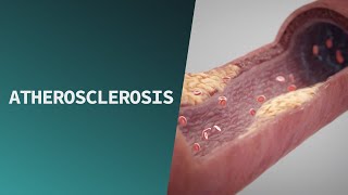 Atherosclerosis  Pathologies [upl. by Aitnecserc330]