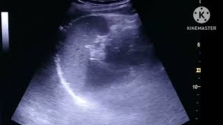 Ureteric stone on Ultrasound [upl. by Otit]