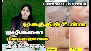 Close Large OPEN PORES in1week tighten and brighten skin Naturally  முகத்தில் உள்ள குழிகளை நீக்க [upl. by Spatz]