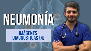 NEUMONÍA  Imágenes diagnósticas Parte 4 [upl. by Aicek]