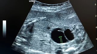 ultrasound case  Anhydramnios due to fetal renal tract anomaly [upl. by Bellanca]