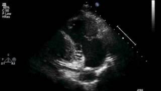 Transthoracic ECHO Parasternal Long RV Inflow View [upl. by Kcerb]