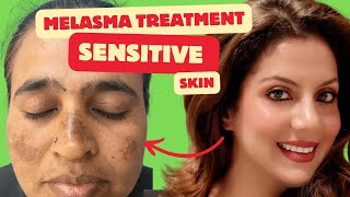 Melasma Treatment for Sensitive skin  Melasma Skincare Routine  Nipun Kapur [upl. by Loreen]