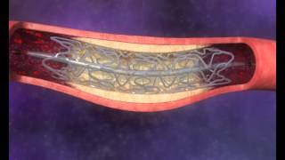 medical animation  stent opening blood flow [upl. by Ewen627]