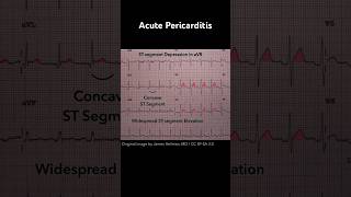 Acute Pericarditis ECG STsegment depression in aVR [upl. by Aihseket308]