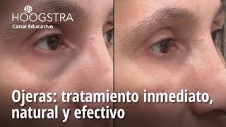 Ojeras tratamiento inmediato natural y efectivo  24130 [upl. by Wasson185]