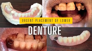 Removable lower partial denture urgent fitting  partial denture dentures missingtooth asmr [upl. by Hannon]