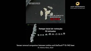 Veneer removal comparison between turbine and LiteTouch™ ErYAG laser [upl. by Rodmun657]