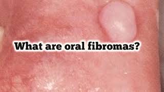 What are oral fibromas Are they benign lesions [upl. by Abbi770]