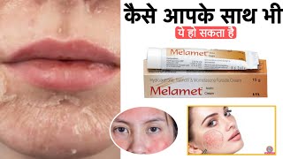 Melamet Cream किन लोगो को use नहीं और करनी चाइए  Review  ￼benefits  Side Effect  How to use ￼ [upl. by Gabriel880]