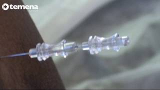 Spinal Anaesthesia with MicroTip® needle Part 22 [upl. by Sal780]