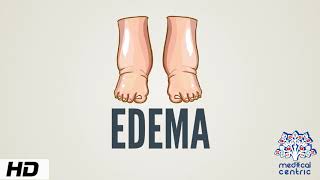 Edema Causes Signs and Symptoms Diagnosis and Treatment [upl. by Rhys]