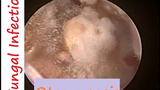 Microsuction Clearance of white Fungus Otomycosis  Ear Wax from Ear Canal in Otitis Media [upl. by Cherianne440]