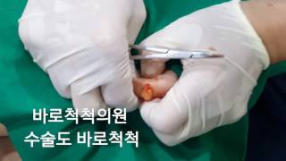 지방종 수술 excision lipoma [upl. by Ayeki783]