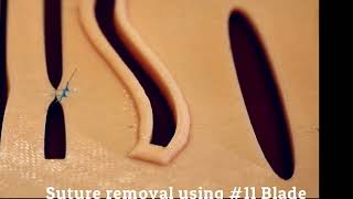 Suture Removal Using 11 scalpel [upl. by Sugihara]