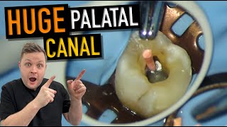 OBTURATING A WIDE PALATAL CANAL  Live RCT  4K Resolution [upl. by Bevin]