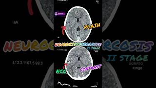 Neurocysticercosis NCC in CT Scan shortshorts ytshorts youtubeshorts radiology medical [upl. by Averil326]