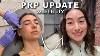 6 Month PRP Under Eye Update [upl. by Yaffit]