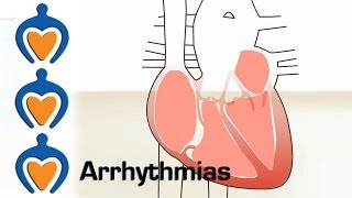 Arrhythmias  What is an arrhythmia and how is it treated [upl. by Aspasia433]