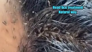 Head lice treatment in natural wayremove head lice in a single daykuto removalhome remedy lice [upl. by Eniluqcaj329]