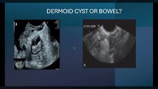 TERATOMA presentation [upl. by Nna]