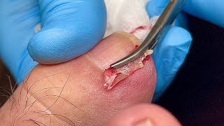 SATISYING INGROWN TOENAIL REMOVAL 😎 [upl. by Anitsyrhk]