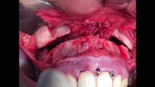 Orthognathic Surgery  Jaw Surgery to correct lip incompetence [upl. by Rema]