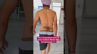 Best scoliosis treatment of severe challenging case by DrRavi scoliosis chiropractic physio ree [upl. by Enialem596]