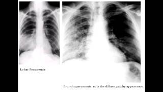 Lobar Pneumonia amp Bronchopneumonia  Organisms amp Characteristics [upl. by Cheng720]