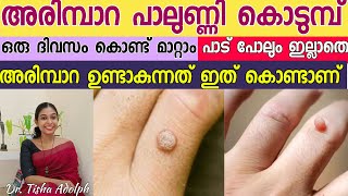 അരിമ്പാറ  പാലുണ്ണി 1 ദിവസം കൊണ്ട് മാറ്റം How To Get Rid Of Warts NEW Dr Tisha Adolph Malayalam [upl. by Yoong]