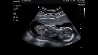 fetus movement ultrasound TheGastroLiverHospitalKanpur gynaecologistdrdiptijainad9310 [upl. by Eamaj762]