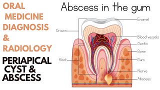 Dental Periapical Cyst amp Abscess  Inflammatory Lesions of Jaws [upl. by Peadar506]