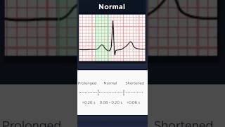 ECG Basics Normal PR interval duration [upl. by Ocsecnarf]