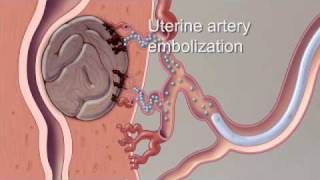 Fibroid Treatment Options  Mayo Clinic [upl. by Smaj901]