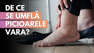 De ce se umflă picioarele vara Sfaturi de la Dr Cristina Neagu [upl. by Gerk]