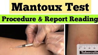 Mantoux Test in Hindi  Tuberculin Skin Test  mantoux test results reading [upl. by Marlowe]