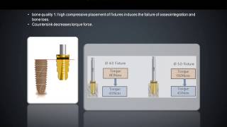 INNO implant surgical protocol [upl. by Htebazle186]