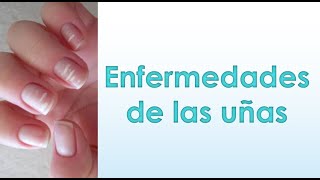 Enfermedades de las uñas ✅ Aprende todo sobre ellas [upl. by Ennaus]