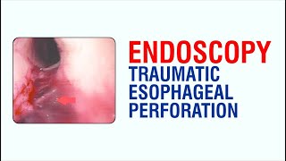 Endoscopy Traumatic Esophageal Perforation  Best Gastroenterologist Doctor in Patna [upl. by Netsew]