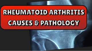 Rheumatoid arthritis lecture1Rheumatoid arthritis causes amppathology [upl. by Menzies]