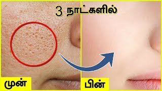 முகத்தில் உள்ள சிறுசிறு குழிகள் OPEN PORES மறைய  Open Large Pores on Face [upl. by Tacklind152]