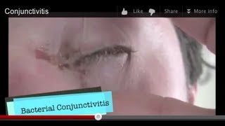 Conjunctivitis [upl. by Enaelem]