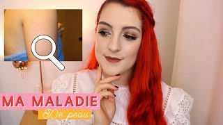 Ma maladie de peau  je vous dis tout 😫 Kératose Pilaire amp mes conseils   LOdoesmakeup [upl. by Spense]