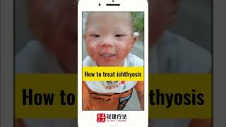 How to treat ichthyosis IchthyosisVulgaris LamellarIchthyosis ErythrodermIcichthyosis dryskin [upl. by Ibby]