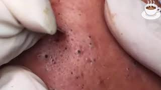 Pimple Pop React Best Ever Blackhead Pimple Removal [upl. by Heall508]