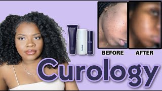 I Tried Curology For 6 Weeks On My Dark Skin  Review For Black Skin [upl. by Uase]